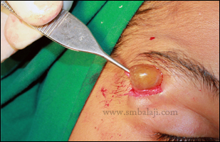 Balaji Dental and Craniofacial Hospital - Dr. S.M Balaji, Maxillofacial
