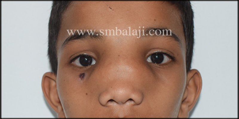 Pre-operative frontal view showing a huge swelling in relation to the nose
