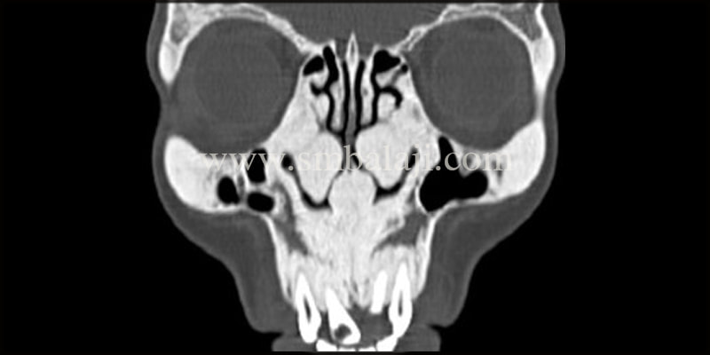 CT scan showing expansile lesion involving the maxilla, zygoma and ethmoidal cells