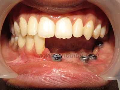Dental implant India
