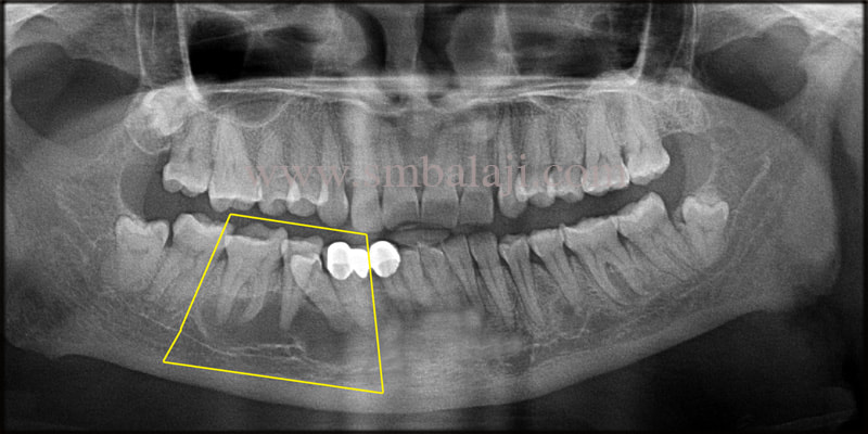 OPG taken shows cystic lesion extending from lower left canine till first molar