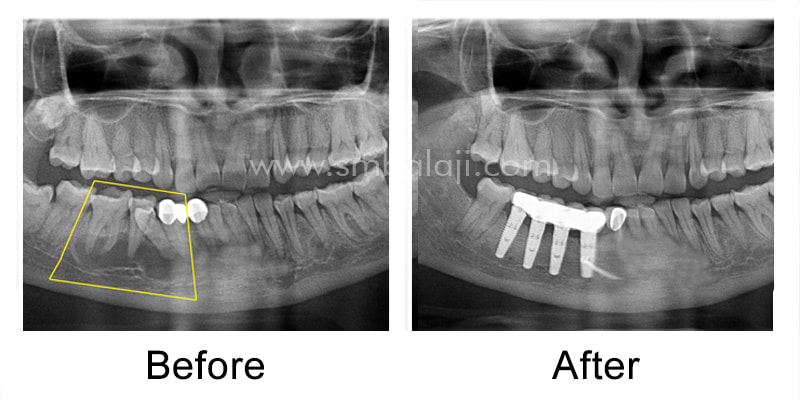 Radiographic image before and after rehabilitation