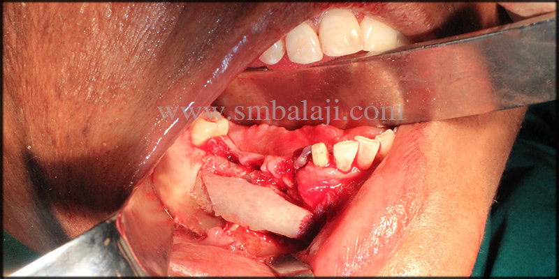 Cystic lesion removed along with the involved teeth and reconstruction of the defective site with rib graft