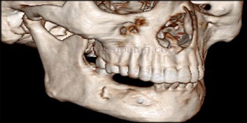 3DCT scan image shows perfectly formed bone with no bone resorption