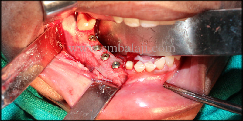 Dental implants fixed with stability under local anesthesia