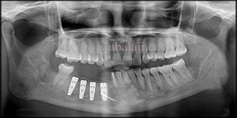 Post operative OPG shows well osseointegrated dental implants with the jaw bone